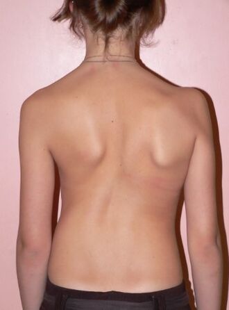 Scoliosis 2 graduko