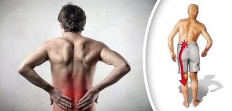 Mina sindromea lumbar osteokondrosia hanketan erradiatzen da